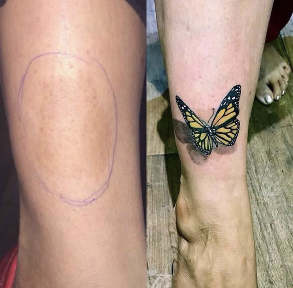 Cover up or tattoo removal and scars coverup