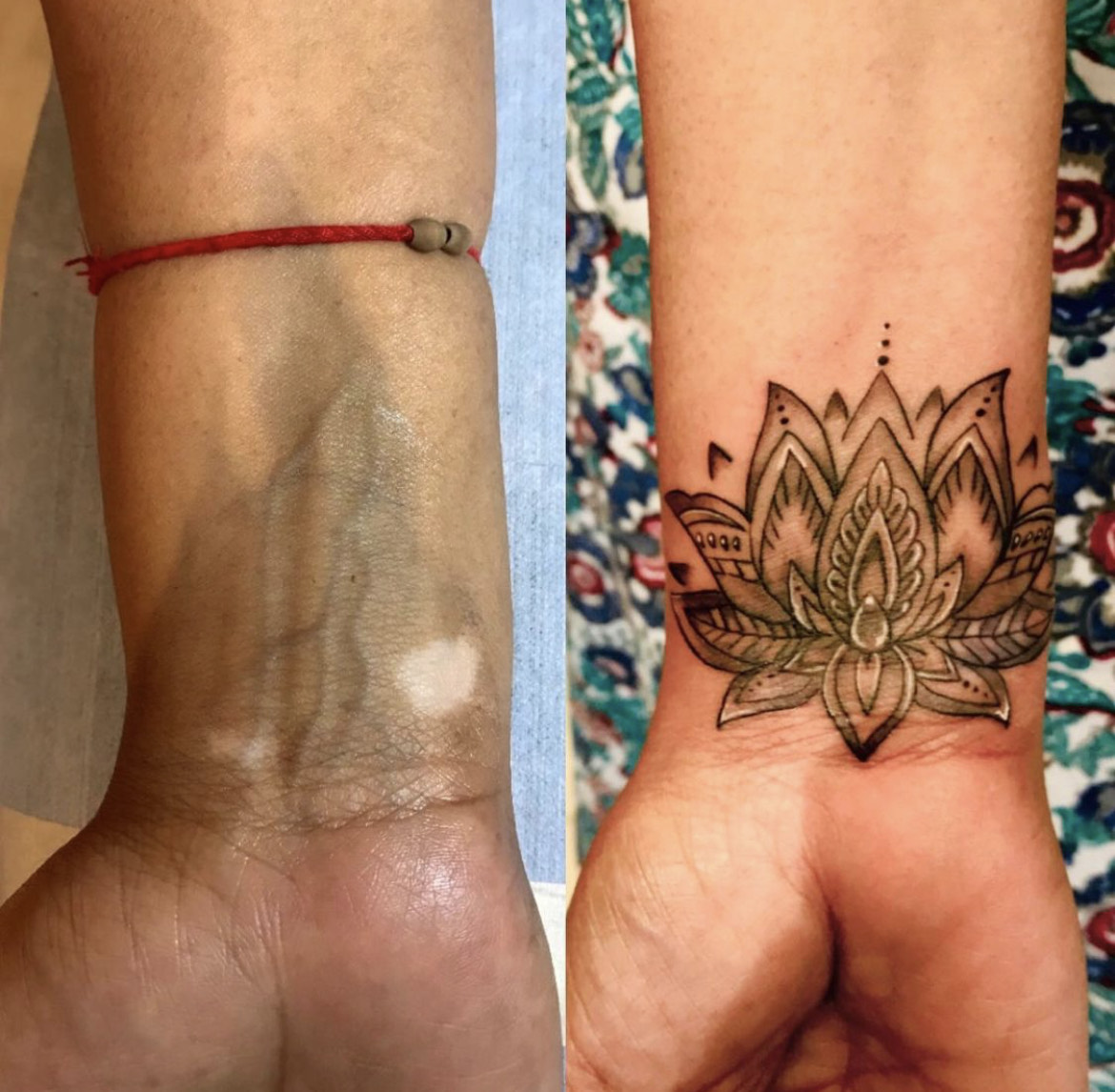 Cover up or tattoo removal and scars coverup