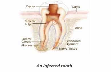 Root Canal Treatment(RCT)