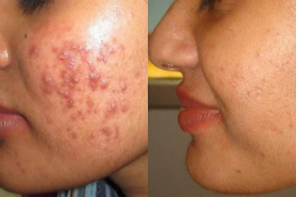 Laser Acne Treatment