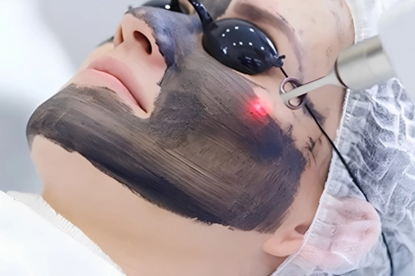 Black Doll Facial (Carbon Facial)