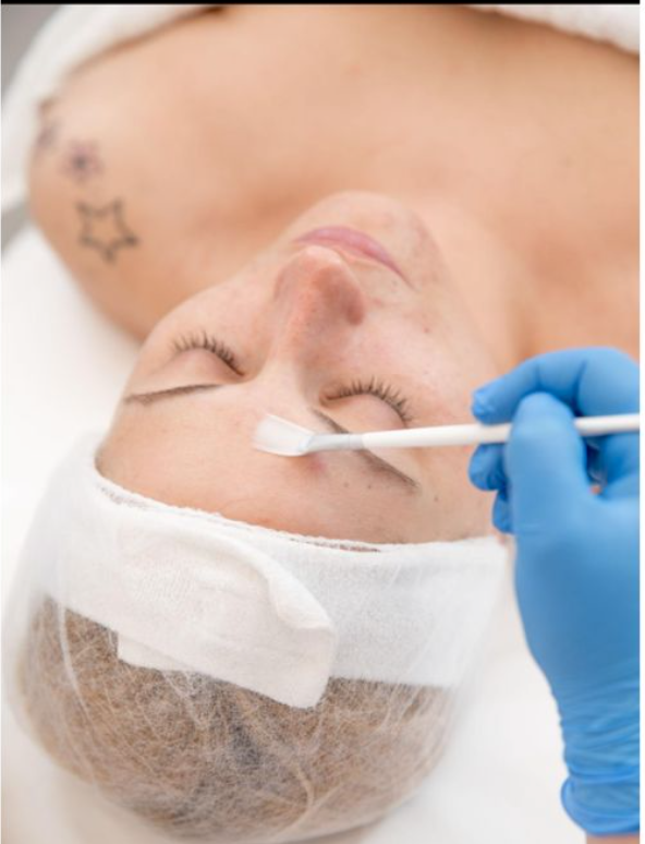 Chemical Peel Treatment
