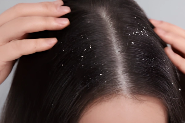 Dandruff Treatment