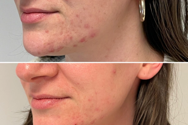 Acne Scar Treatment