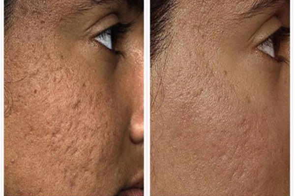 Laser Skin Resurfacing