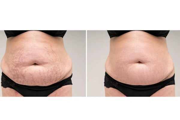 Laser Stretch Mark Reduction