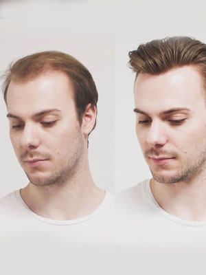 Human Hair Replacement in Noida|Noida Sec 15|Noida Sec 16|Noida Sec 18|Botanical Garden|Golf Course|Noida Sector 34|Noida Sector 37|Noida Bhangel|Phase 2 Noida|Noida Sector 61|Noida Sector 62|Noida Sector 58|Noida Sector 56|Indirapuram|Vasundhra ... Human Hair Replacement in Noida|Noida Sec 15|Noida Sec 16|Noida Sec 18|Botanical Garden|Golf Course|Noida Sector 34|Noida Sector 37|Noida Bhangel|Phase 2 Noida|Noida Sector 61|Noida Sector 62|Noida Sector 58|Noida Sector 56|Indirapuram|Vasundhra ...