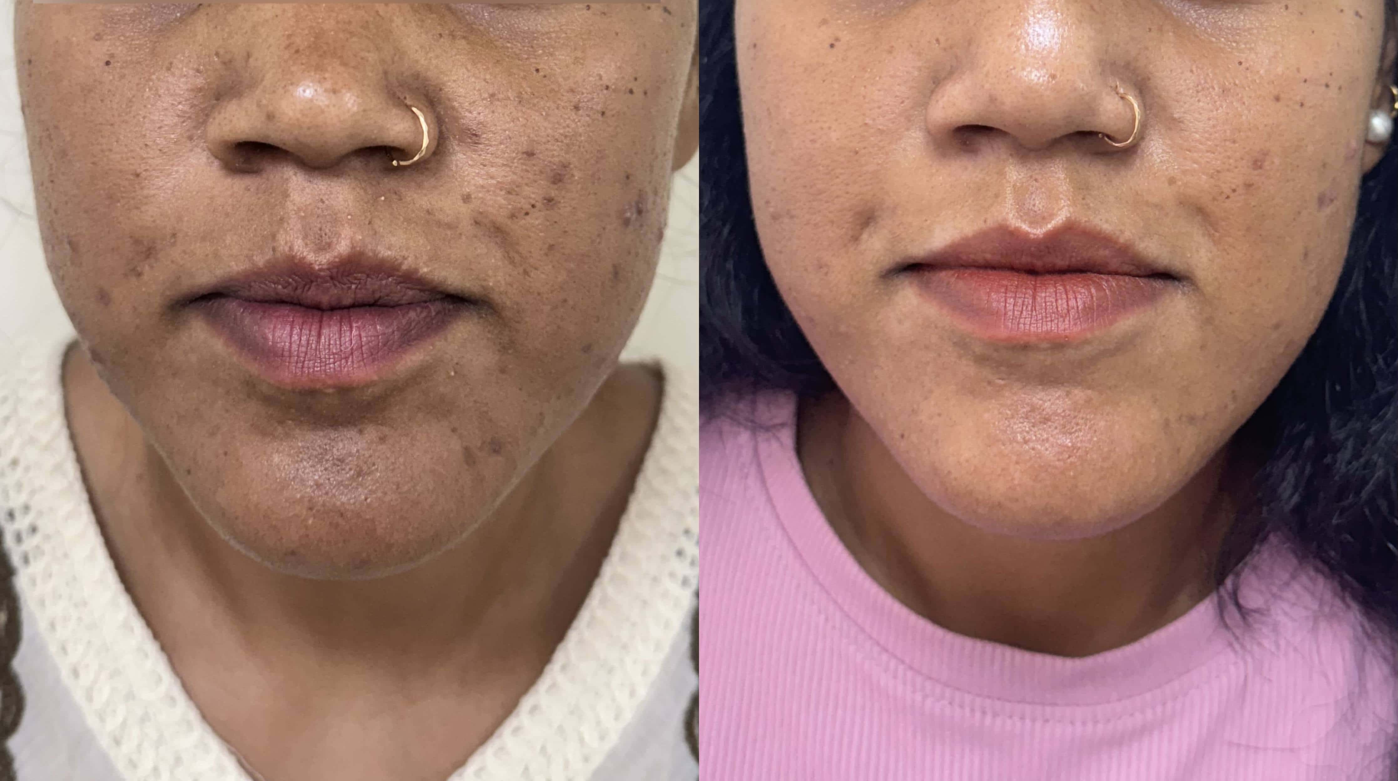 How to Reduce Acne Marks & Treat Active Acne | Expert Guide | QALA Aesthetics