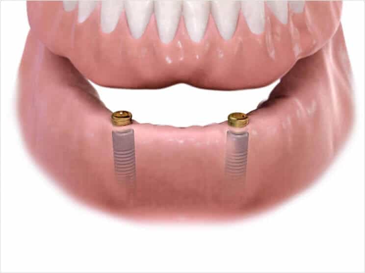 Implant supported bridge