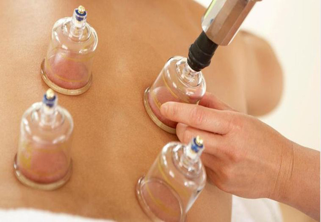 CUPPING THERAPY