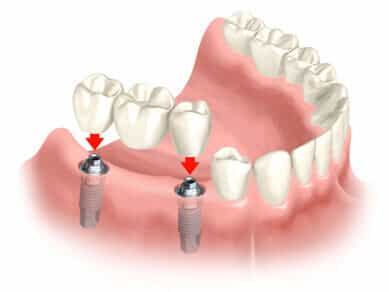 Implants prosthesis 