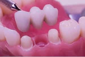 Fixed prosthodontics