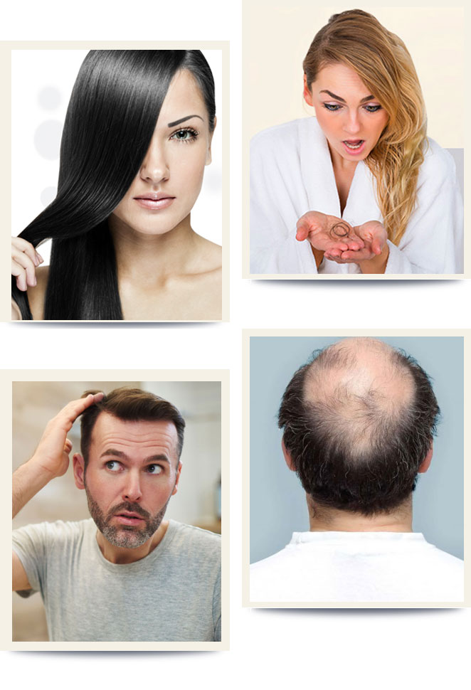 Non-Surgical Hair Replacement|Best Treatment In Noida|Greater Noida|Delhi