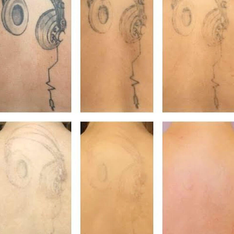 Tattoo Removal