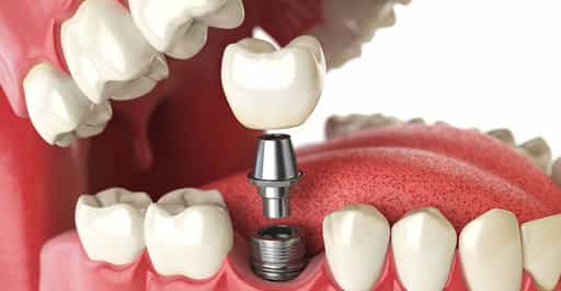 Dental implants