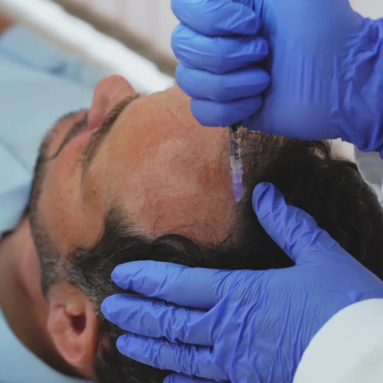 Hair Loss & Replacement Treatments